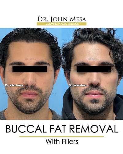 Buccal Fat Pad Removal for Men Before & After Gallery - Patient 404824 - Image 1