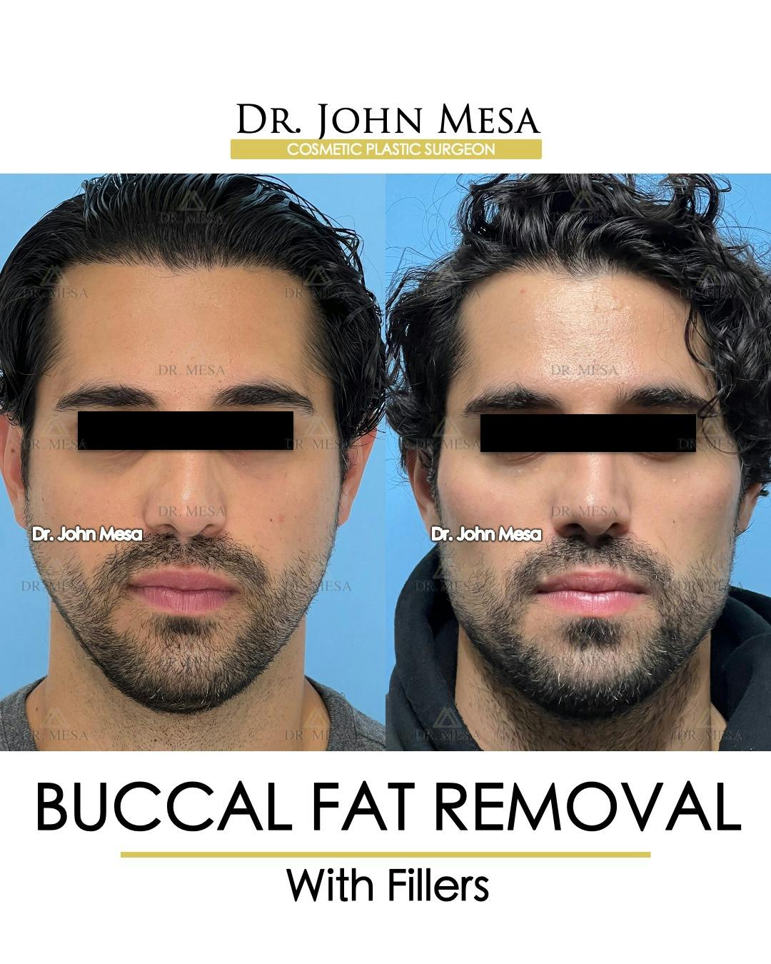 Buccal Fat Pad Removal for Men Before & After Gallery - Patient 404824 - Image 1