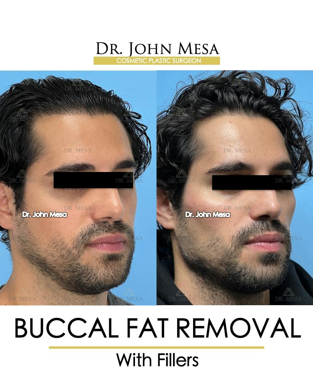 Buccal Fat Pad Removal for Men Before & After Gallery - Patient 404824 - Image 2