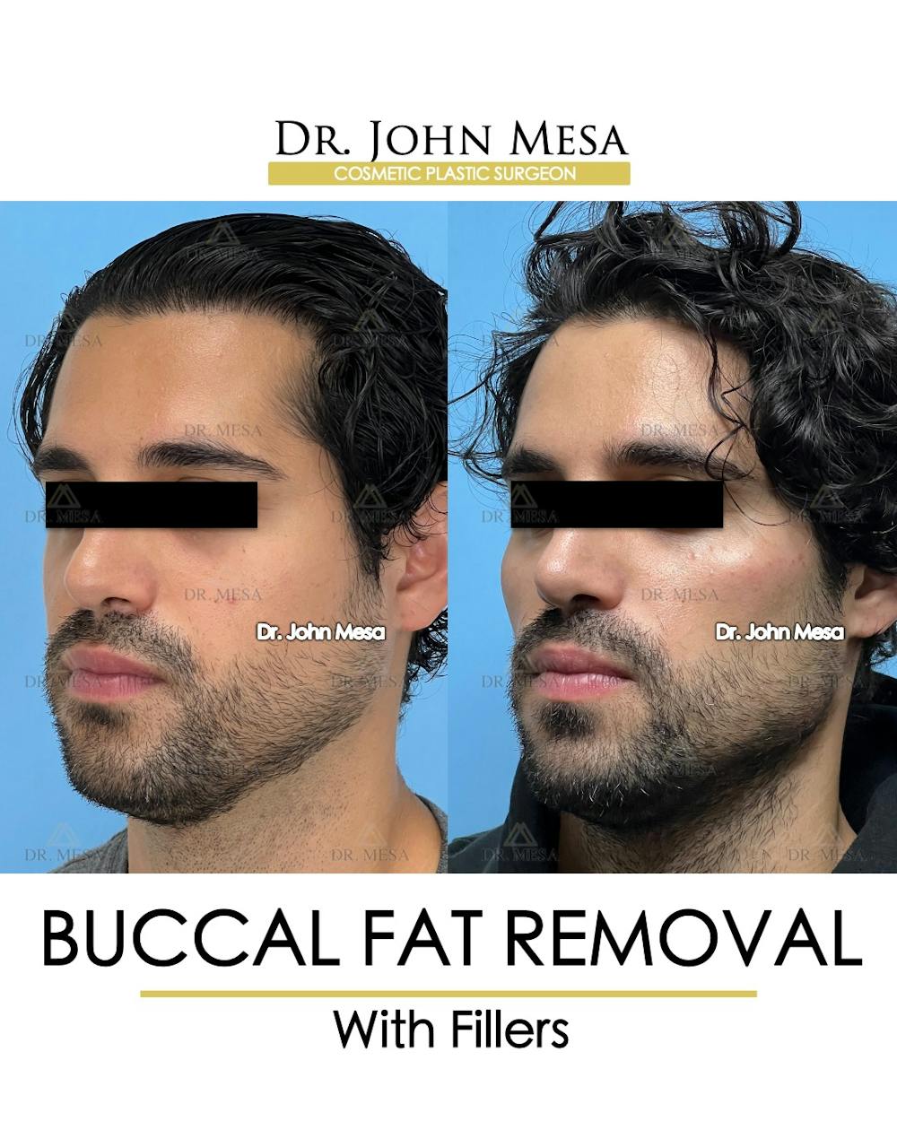 Buccal Fat Pad Removal for Men Before & After Gallery - Patient 404824 - Image 4