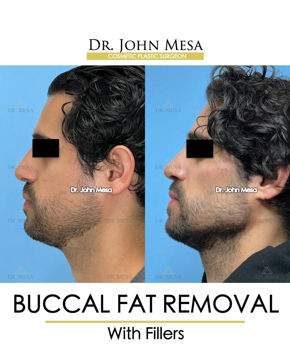 Buccal Fat Pad Removal for Men Before & After Gallery - Patient 404824 - Image 5
