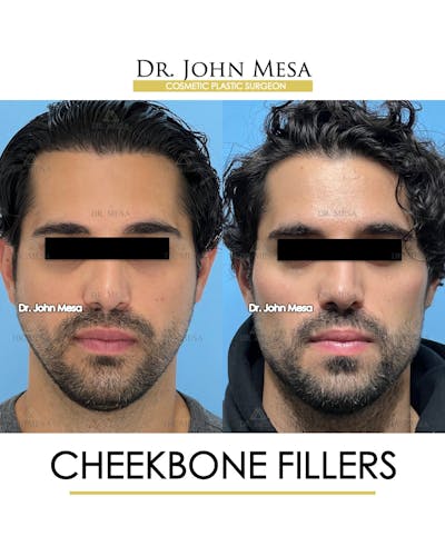 Cheekbone Filler Before & After Gallery - Patient 394612 - Image 1