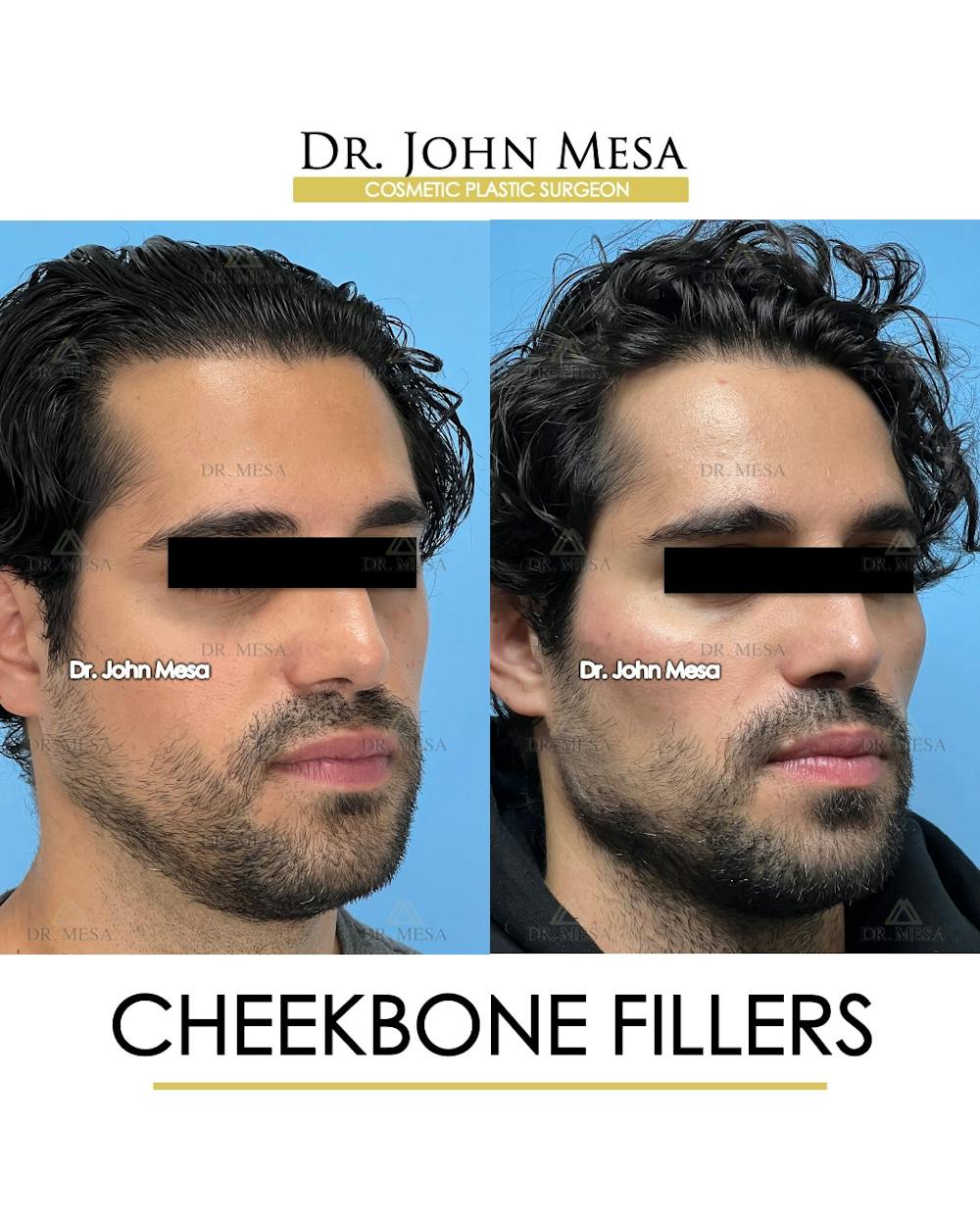 Cheekbone Filler Before & After Gallery - Patient 394612 - Image 2