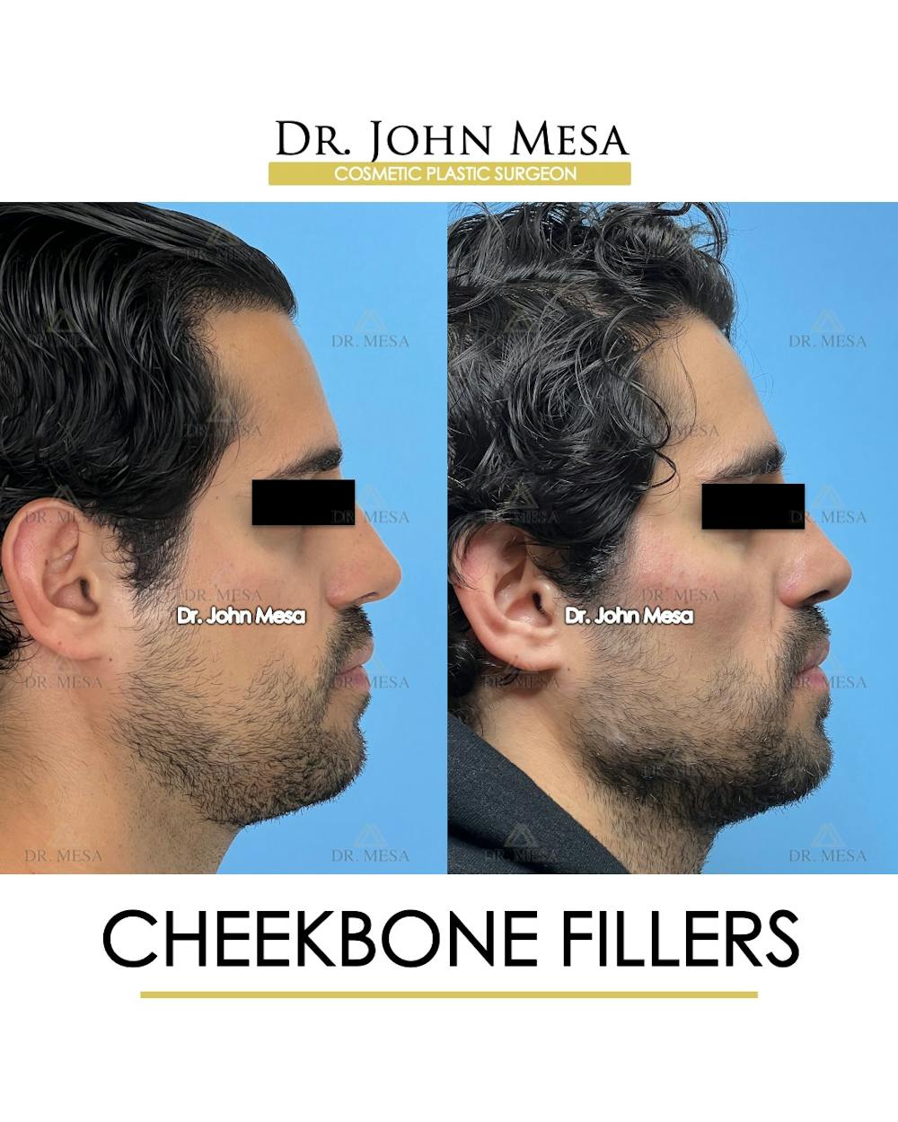 Cheekbone Filler Before & After Gallery - Patient 394612 - Image 3