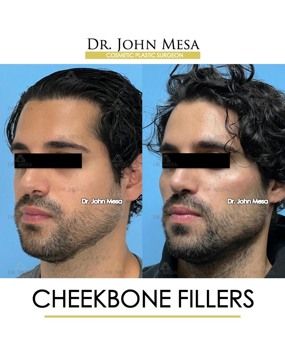 Cheekbone Filler Before & After Gallery - Patient 394612 - Image 4
