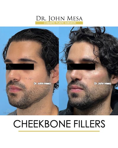 Cheekbone Filler Before & After Gallery - Patient 394612 - Image 4