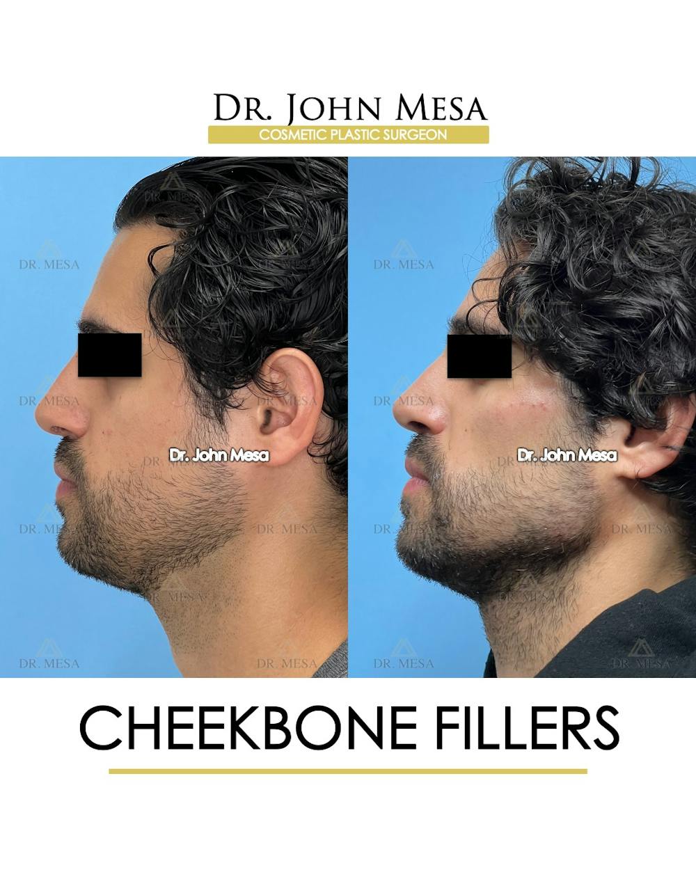 Cheekbone Filler Before & After Gallery - Patient 394612 - Image 5