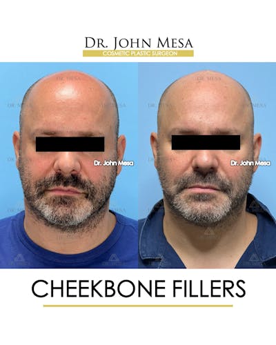 Cheekbone Filler Before & After Gallery - Patient 952889 - Image 1