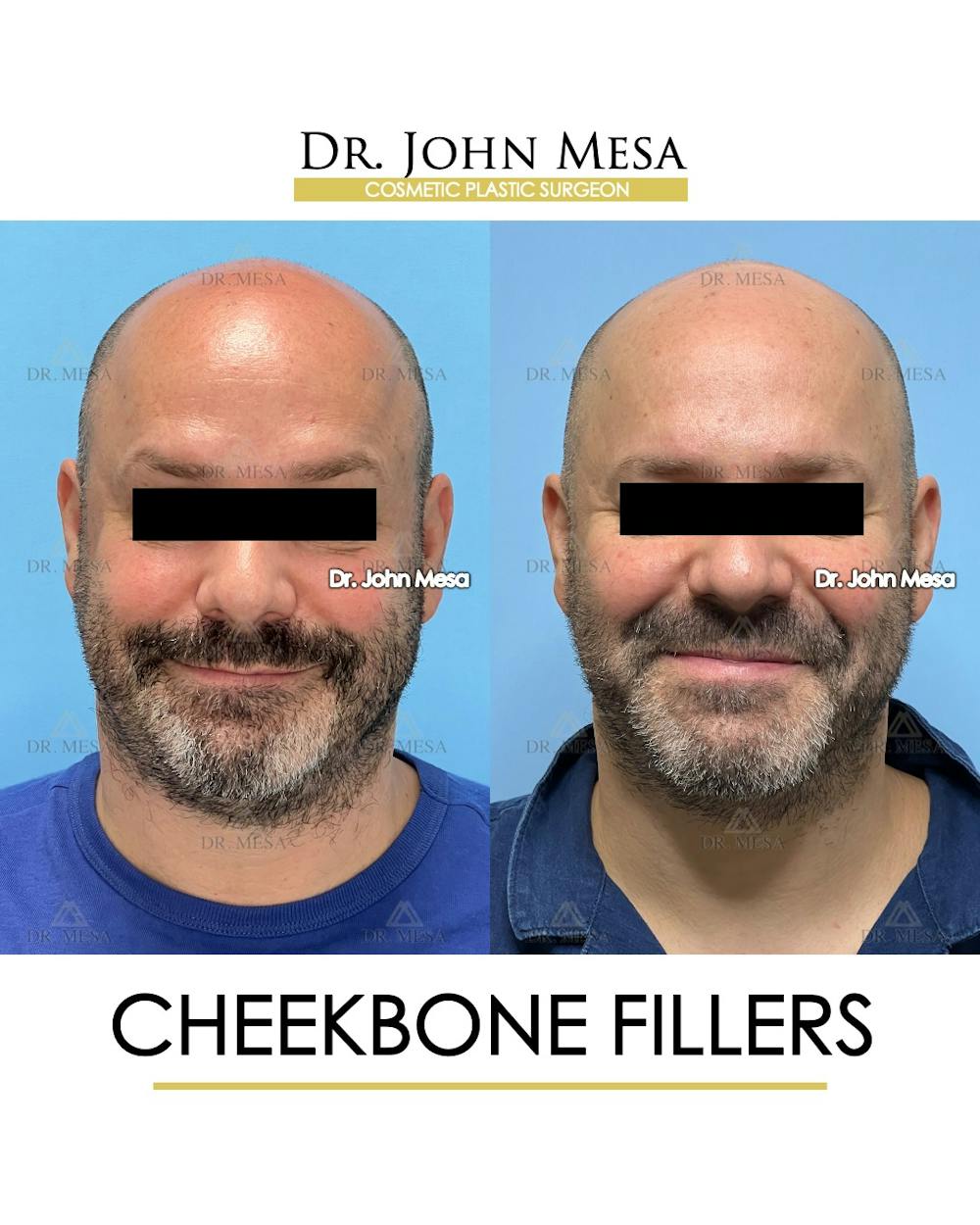 Cheekbone Filler Before & After Gallery - Patient 952889 - Image 2