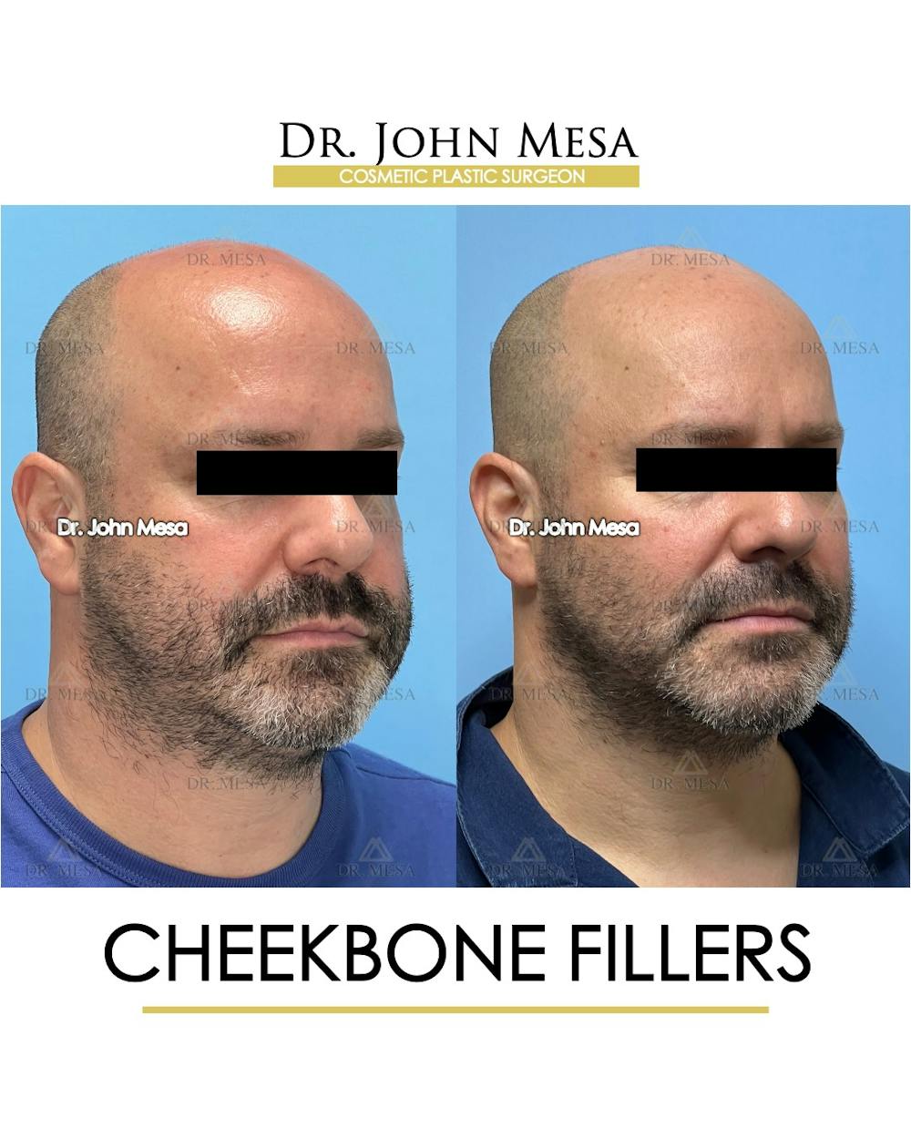 Cheekbone Filler Before & After Gallery - Patient 952889 - Image 3