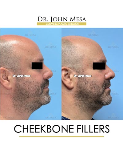 Cheekbone Filler Before & After Gallery - Patient 952889 - Image 4