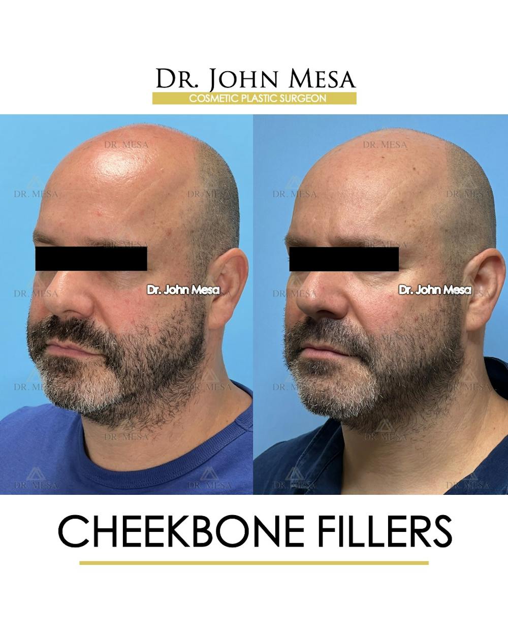 Cheekbone Filler Before & After Gallery - Patient 952889 - Image 5
