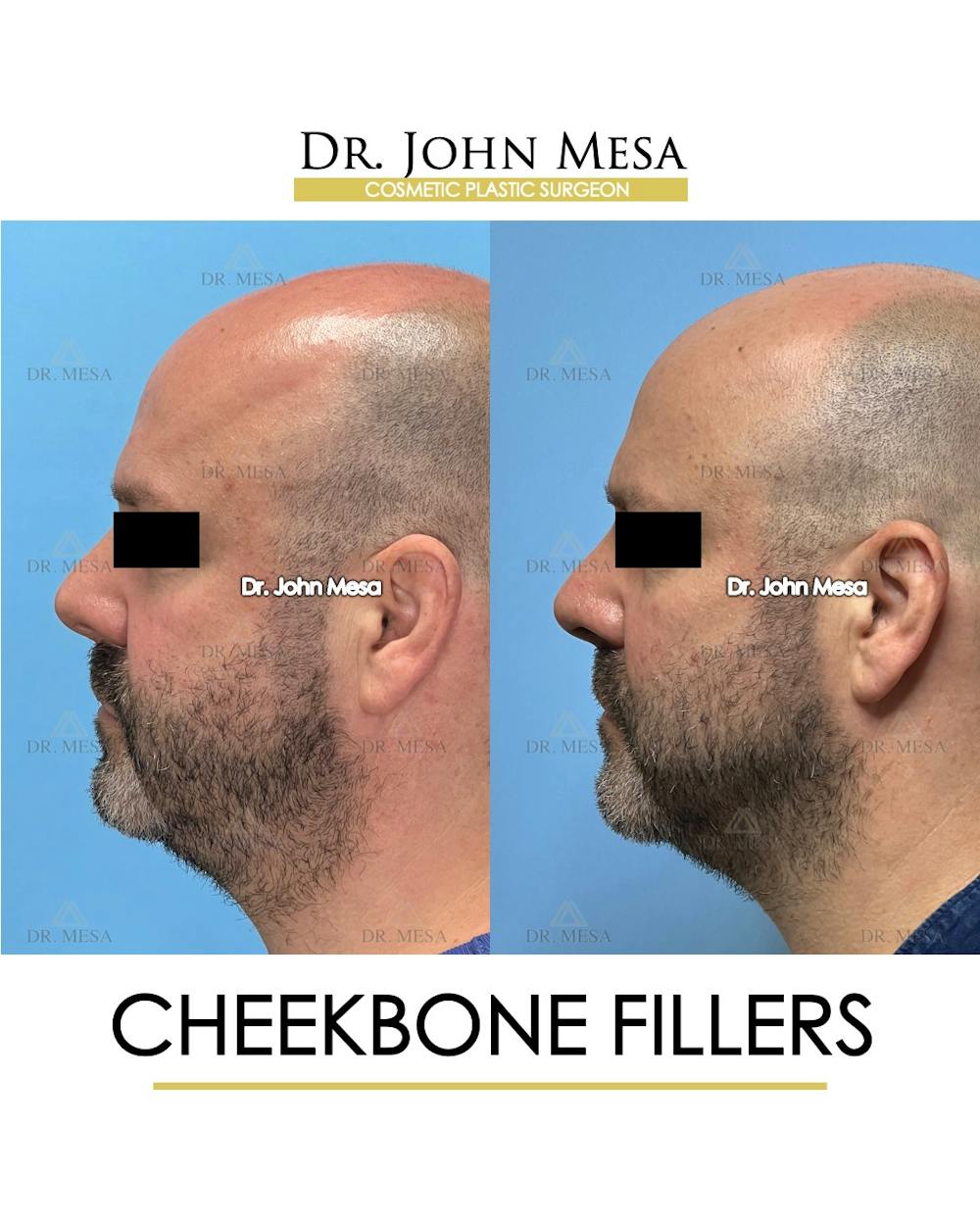 Cheekbone Filler Before & After Gallery - Patient 952889 - Image 6