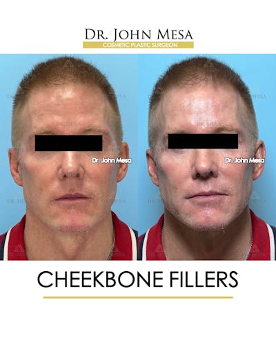 Cheekbone Filler Before & After Gallery - Patient 105393 - Image 1