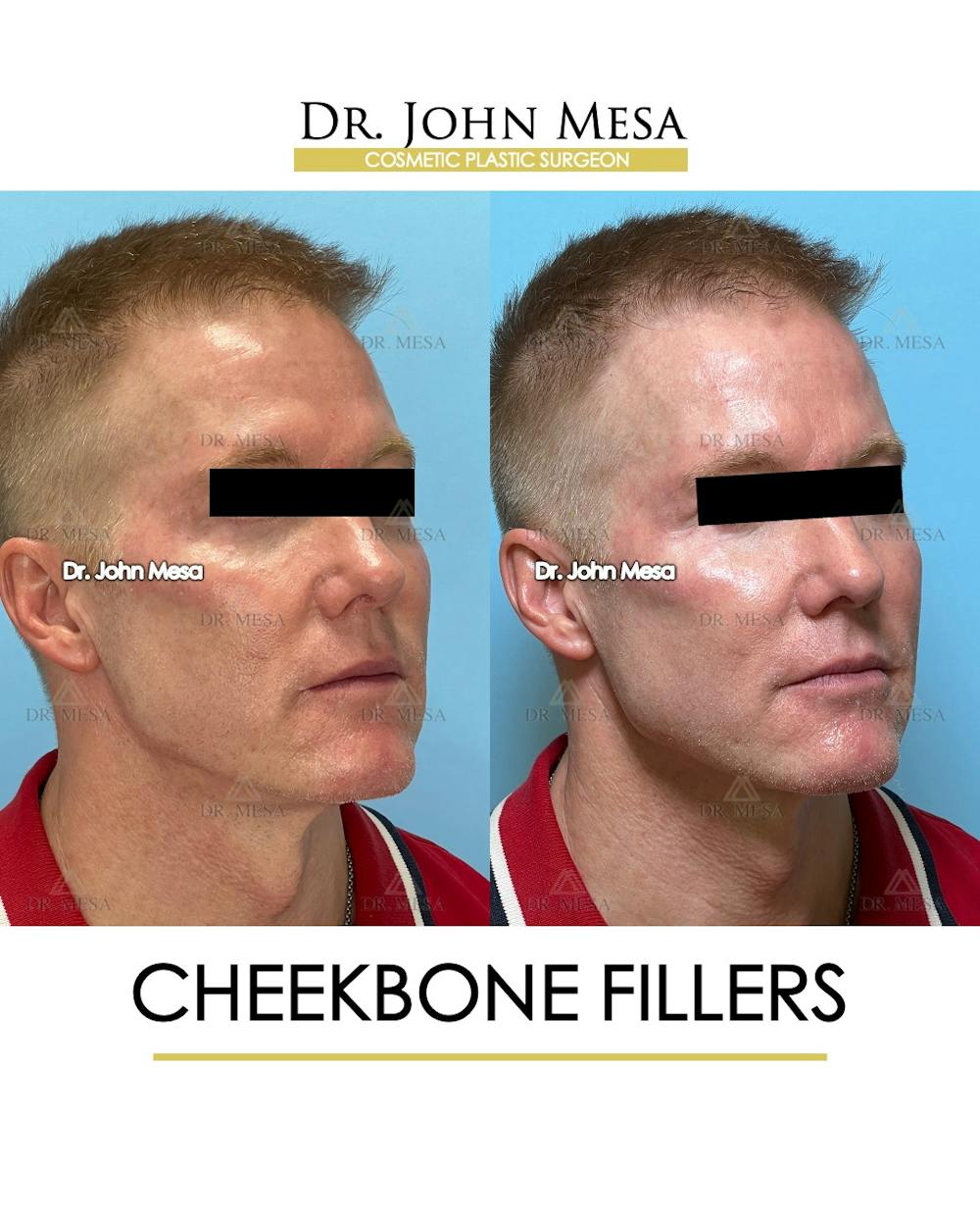 Cheekbone Filler Before & After Gallery - Patient 105393 - Image 2