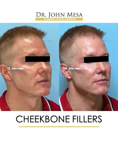 Cheekbone Filler Before & After Gallery - Patient 105393 - Image 2