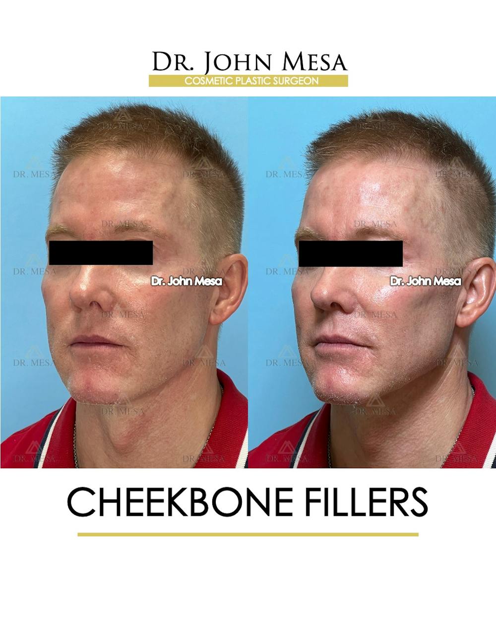 Cheekbone Filler Before & After Gallery - Patient 105393 - Image 3