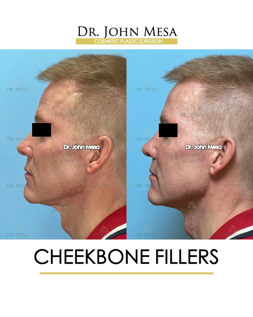 Cheekbone Filler Before & After Gallery - Patient 105393 - Image 4