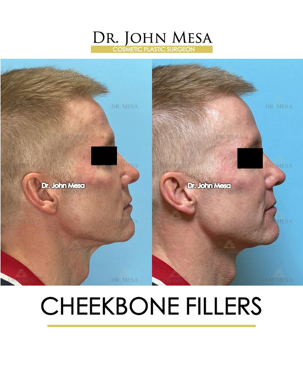 Cheekbone Filler Before & After Gallery - Patient 105393 - Image 5