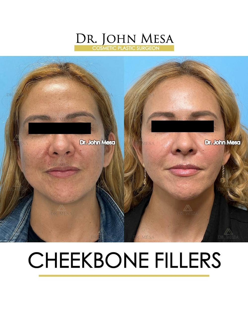 Cheekbone Filler Before & After Gallery - Patient 710220 - Image 1