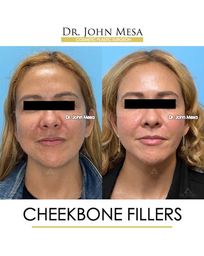 Cheekbone Filler Before & After Gallery - Patient 710220 - Image 1