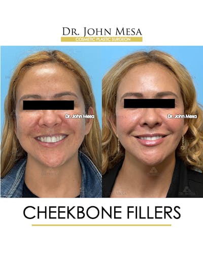 Cheekbone Filler Before & After Gallery - Patient 710220 - Image 2