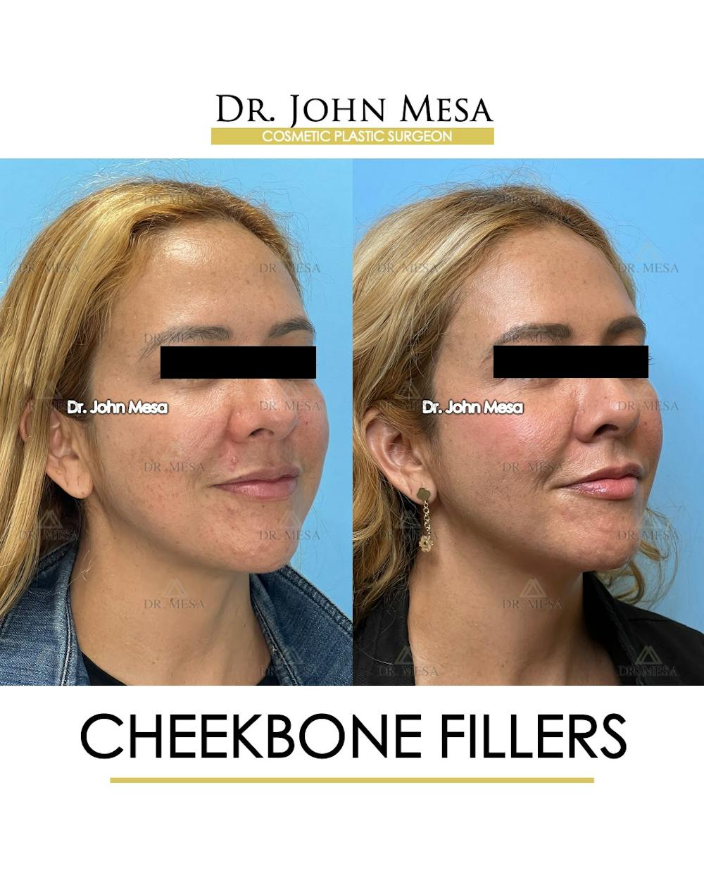 Cheekbone Filler Before & After Gallery - Patient 710220 - Image 3