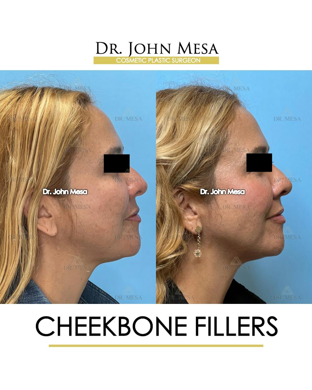 Cheekbone Filler Before & After Gallery - Patient 710220 - Image 4