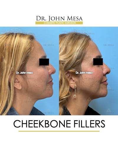 Cheekbone Filler Before & After Gallery - Patient 710220 - Image 4