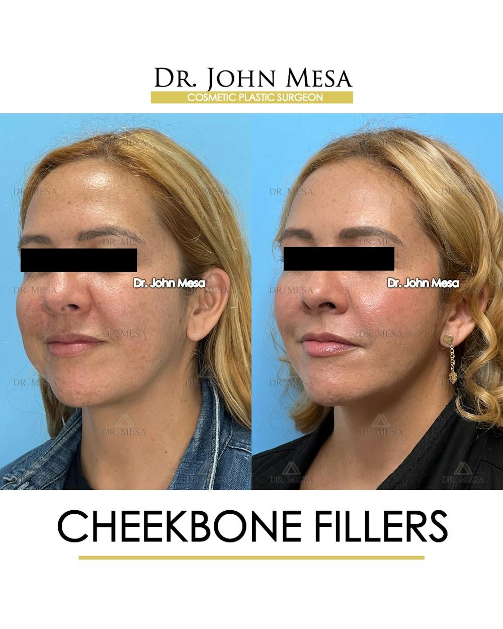 Cheekbone Filler Before & After Gallery - Patient 710220 - Image 5