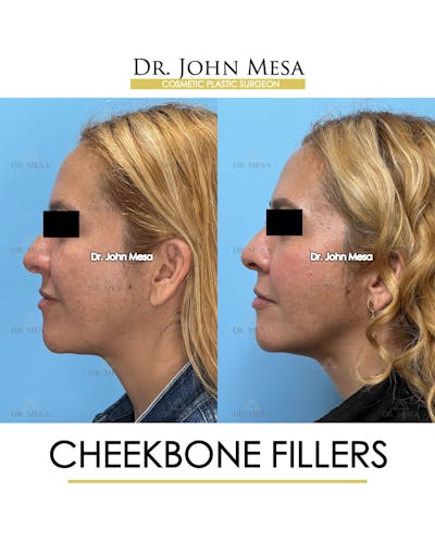 Cheekbone Filler Before & After Gallery - Patient 710220 - Image 6