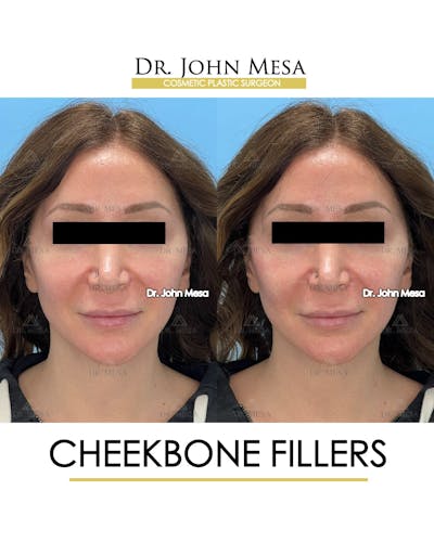 Cheekbone Filler Before & After Gallery - Patient 282472 - Image 1