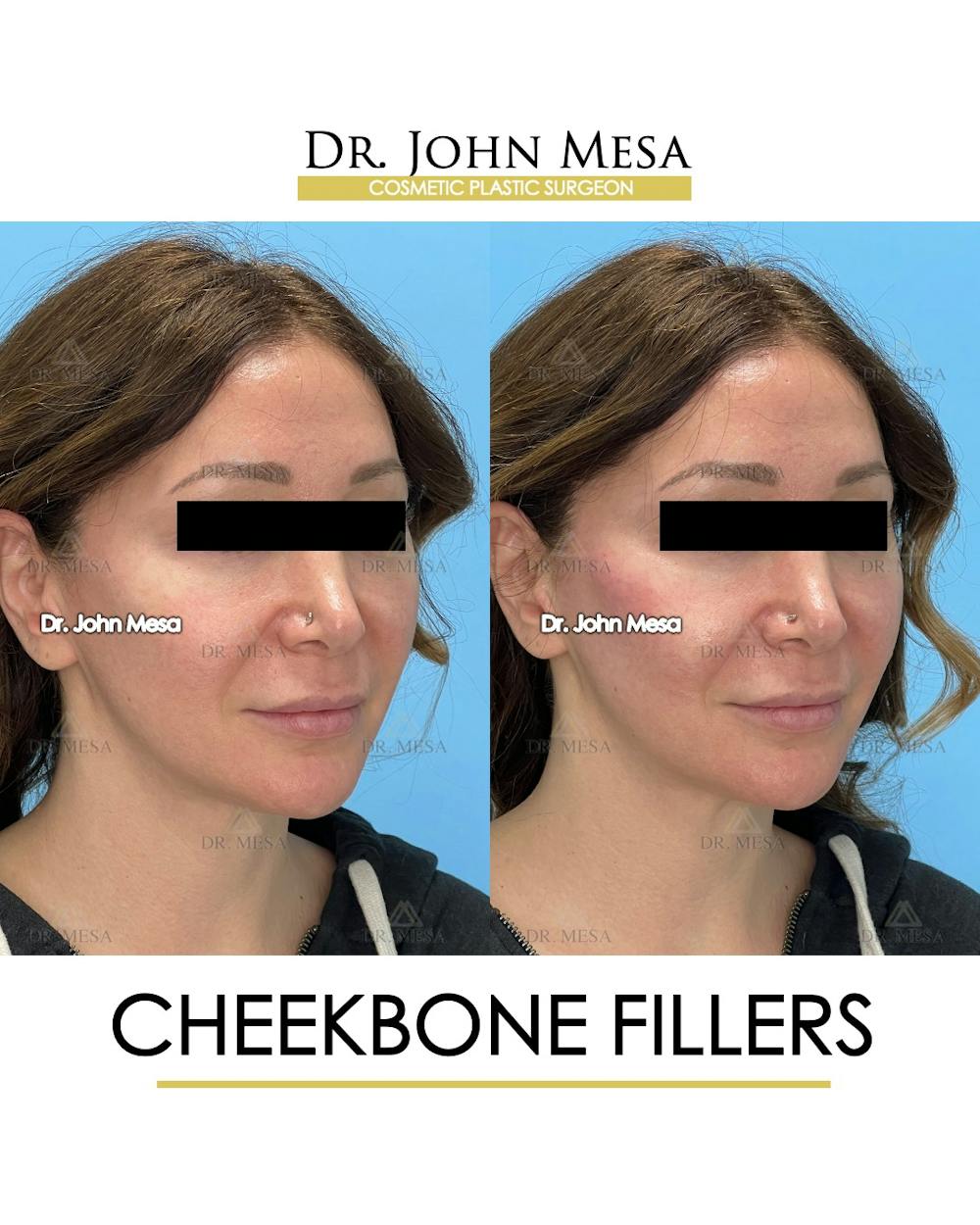 Cheekbone Filler Before & After Gallery - Patient 282472 - Image 2