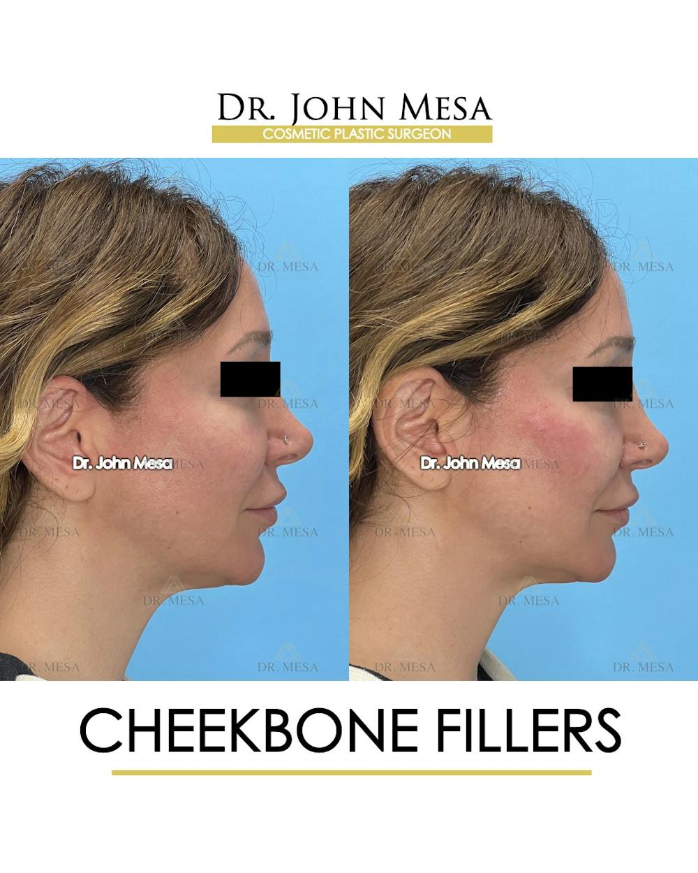Cheekbone Filler Before & After Gallery - Patient 282472 - Image 3