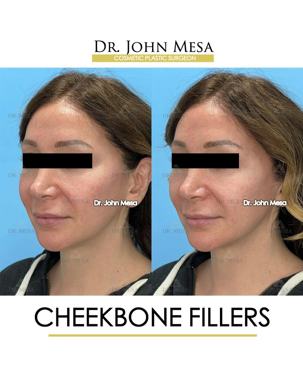 Cheekbone Filler Before & After Gallery - Patient 282472 - Image 4