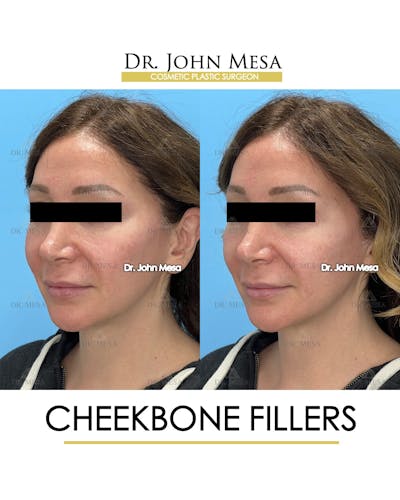 Cheekbone Filler Before & After Gallery - Patient 282472 - Image 4