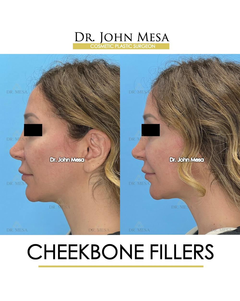 Cheekbone Filler Before & After Gallery - Patient 282472 - Image 5