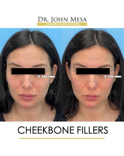 Cheekbone Filler Before & After Gallery - Patient 197458 - Image 1