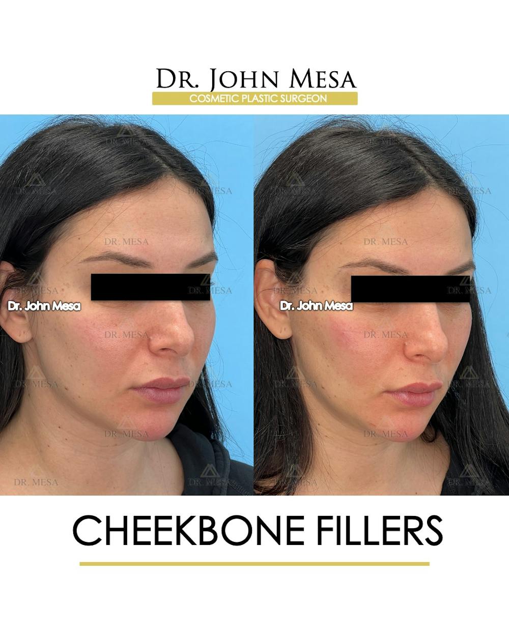 Cheekbone Filler Before & After Gallery - Patient 197458 - Image 2