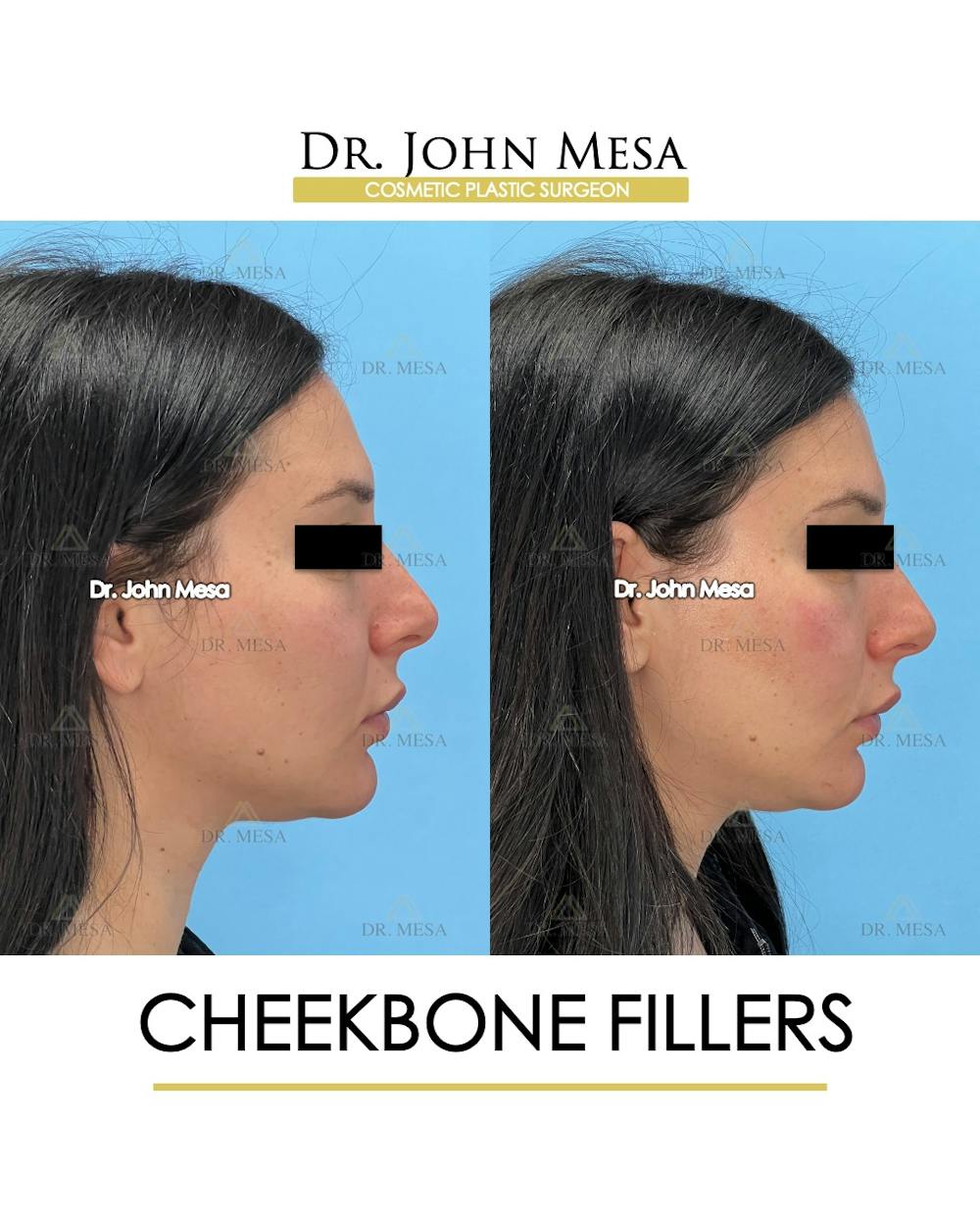 Cheekbone Filler Before & After Gallery - Patient 197458 - Image 3