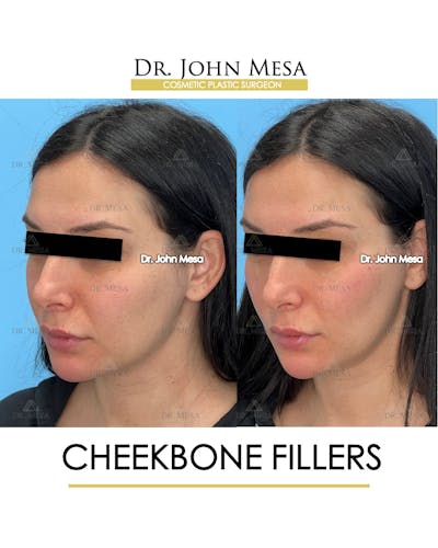 Cheekbone Filler Before & After Gallery - Patient 197458 - Image 4