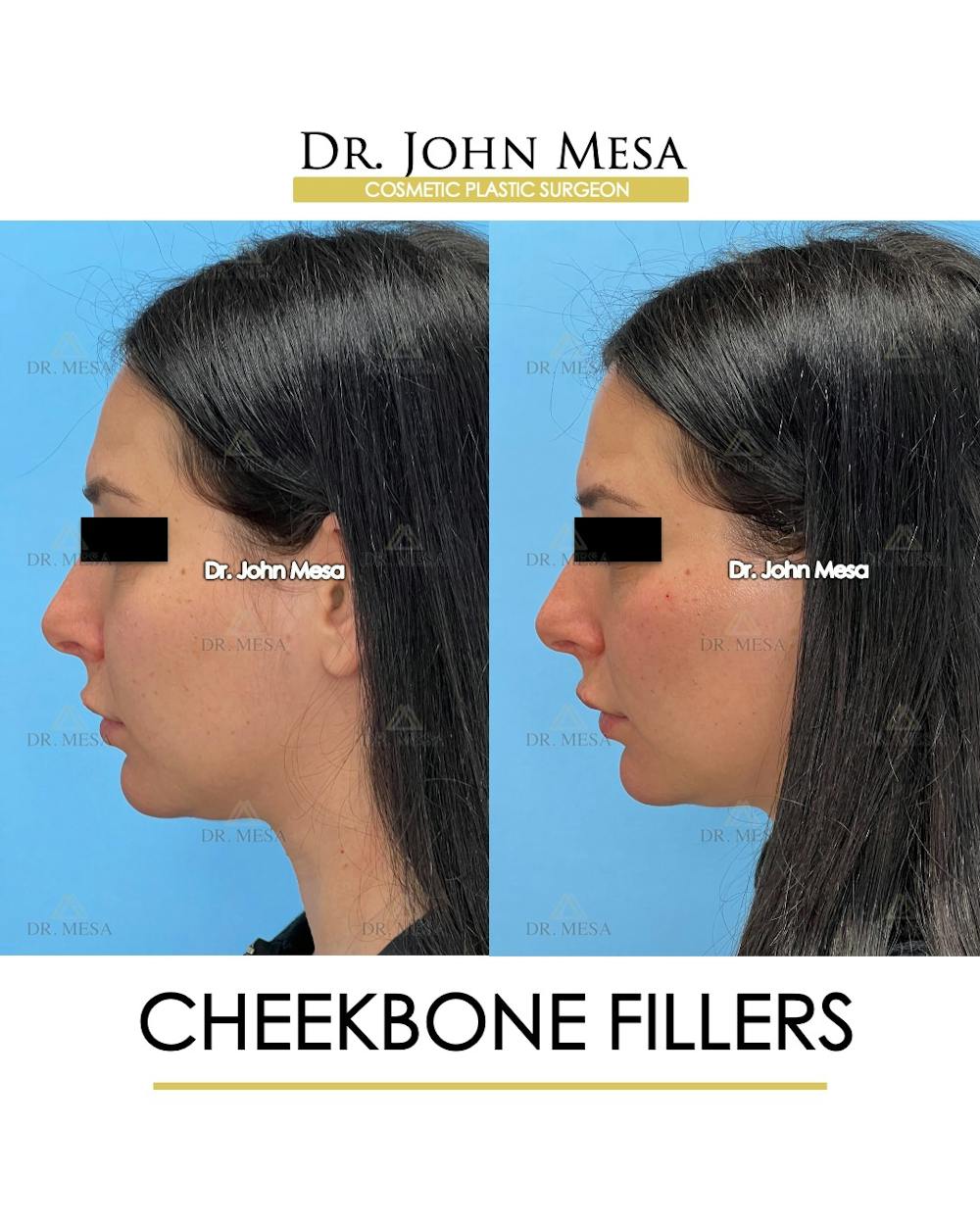 Cheekbone Filler Before & After Gallery - Patient 197458 - Image 5