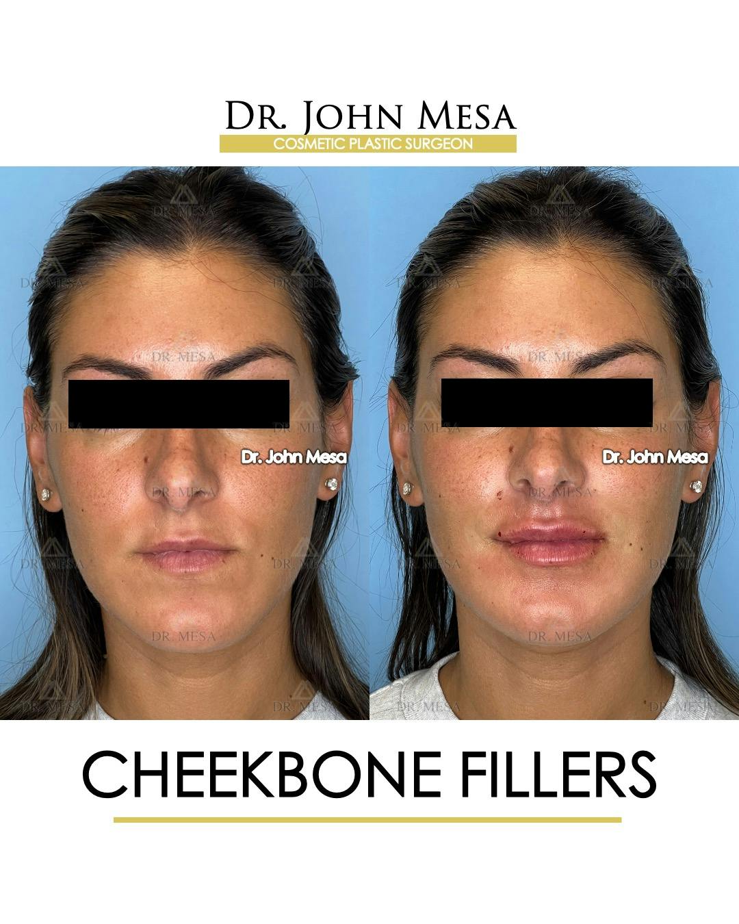Cheekbone Filler Before & After Gallery - Patient 400691 - Image 1