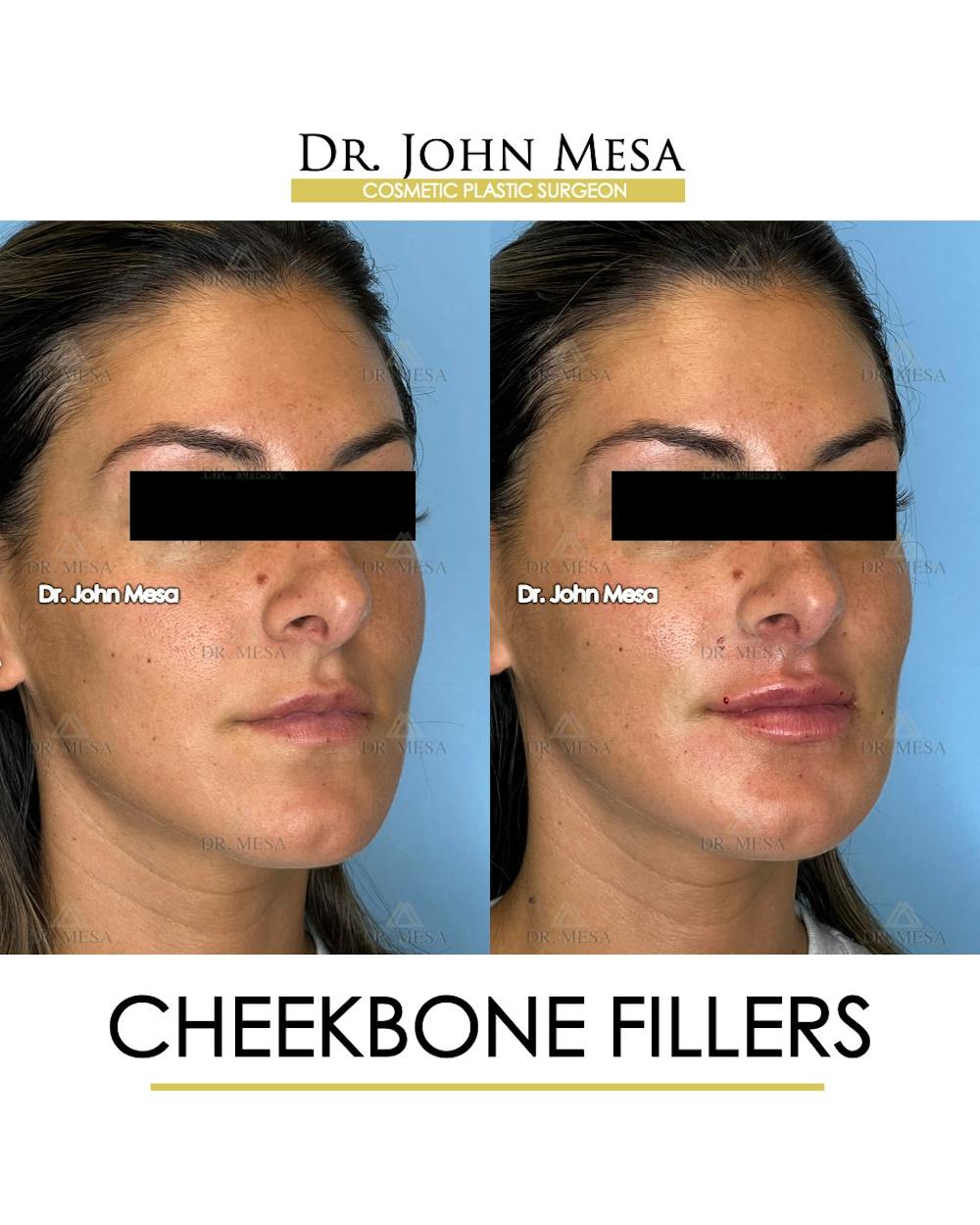 Cheekbone Filler Before & After Gallery - Patient 400691 - Image 2