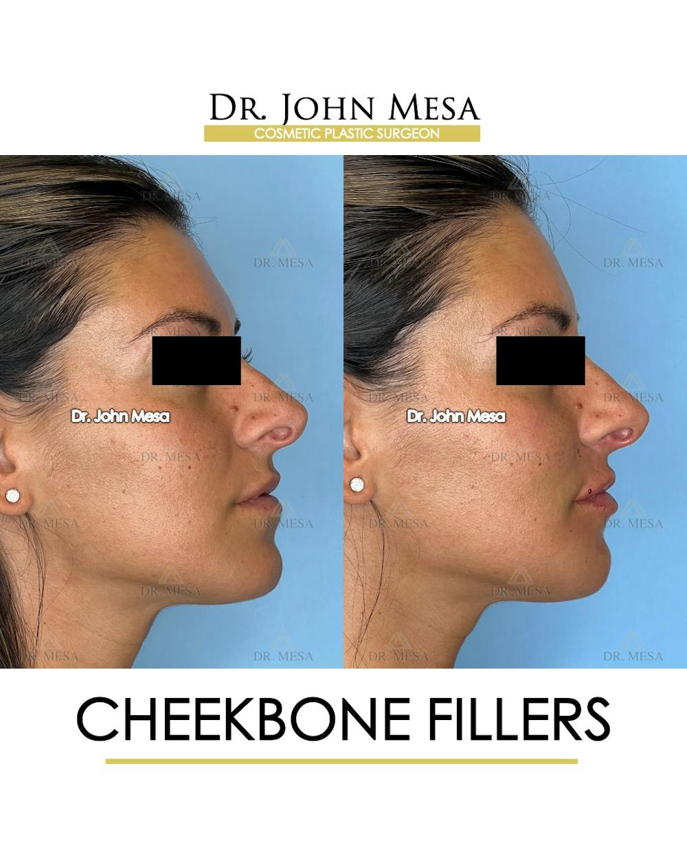 Cheekbone Filler Before & After Gallery - Patient 400691 - Image 3