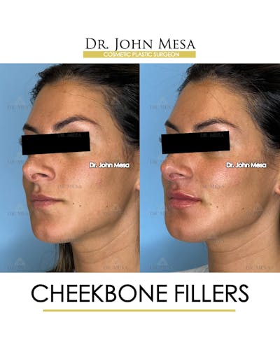 Cheekbone Filler Before & After Gallery - Patient 400691 - Image 4