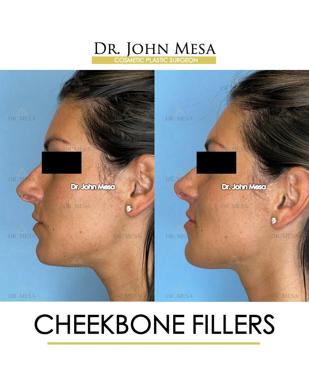 Cheekbone Filler Before & After Gallery - Patient 400691 - Image 5