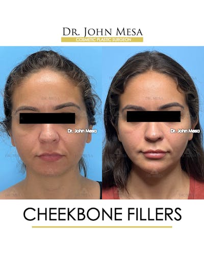 Cheekbone Filler Before & After Gallery - Patient 721648 - Image 1