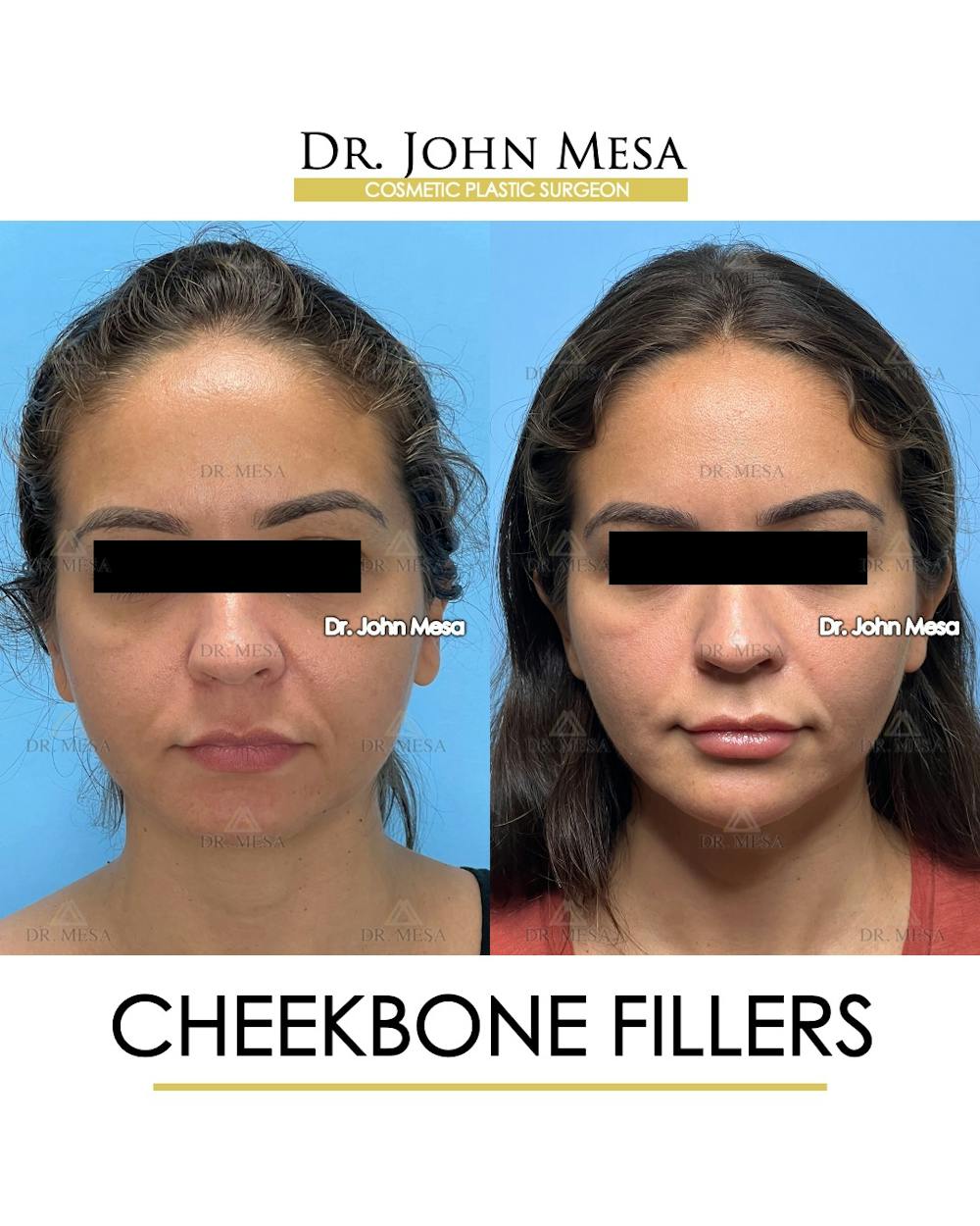 Cheekbone Filler Before & After Gallery - Patient 721648 - Image 1