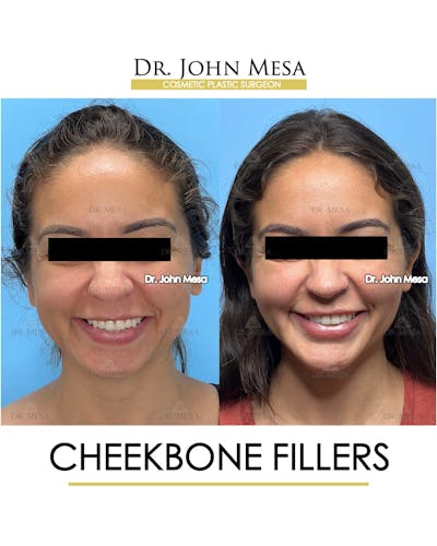 Cheekbone Filler Before & After Gallery - Patient 721648 - Image 2